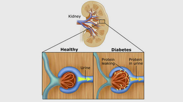 actos and chronic kidney disease